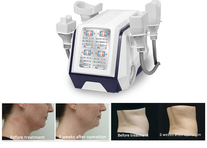 Portable 360 Cryolipolysis Body Slimming Machine 1000W For Fat Burning Weight Loss